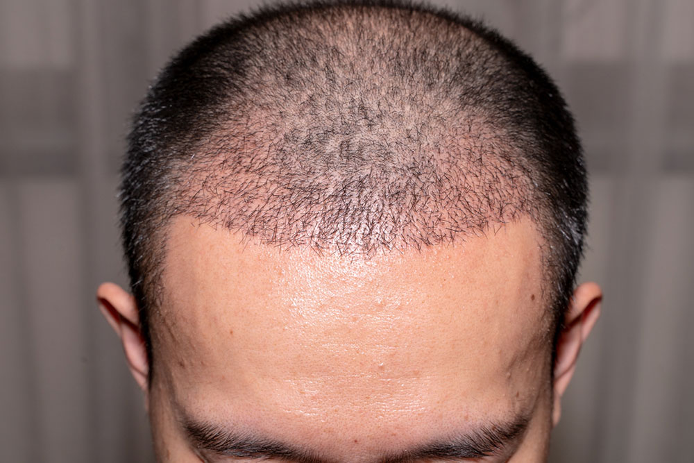 Hair Transplant – Types, Benefits, and Tips to Choose a Doctor