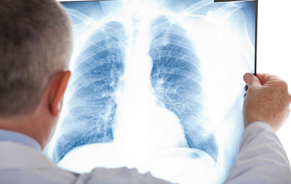 A few things you should know about mesothelioma cancer