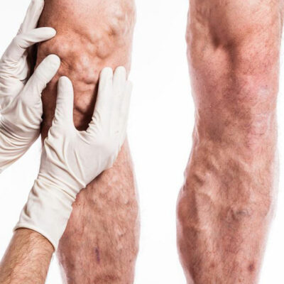 Things You Must Know About Deep Vein Thrombosis